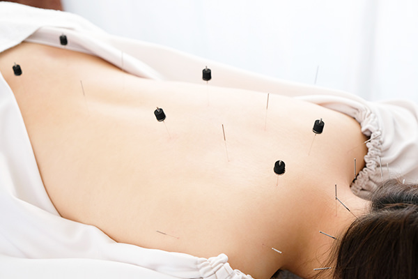 STEP5. 鍼灸治療（施術）を行います
